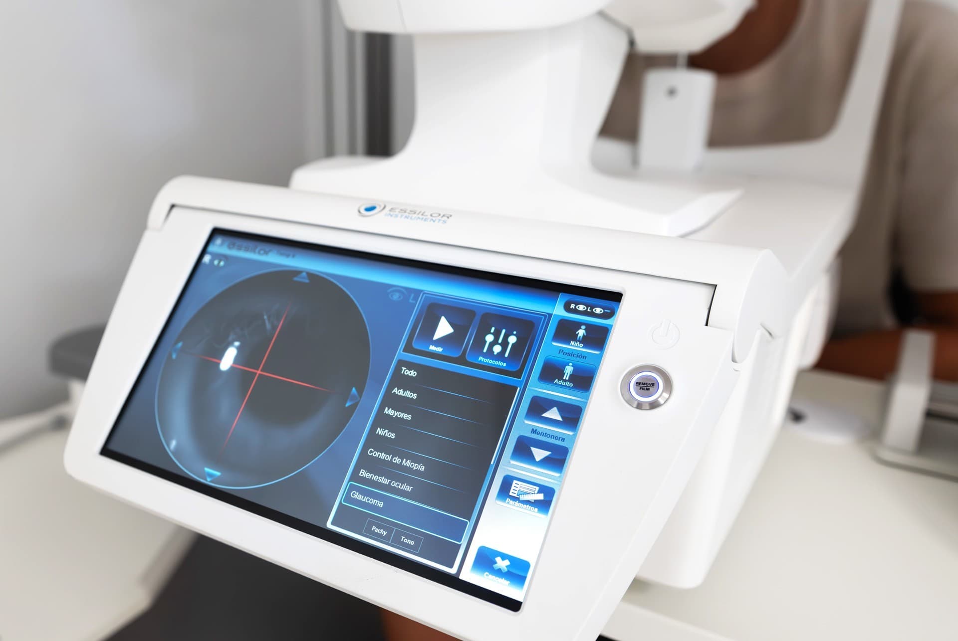 ¿Qué es el queratocono?